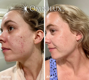 Omnilux Contour Face