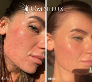Omnilux Contour Face
